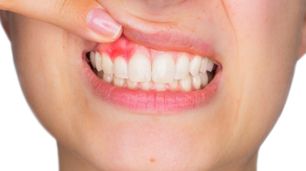 Gingivitis